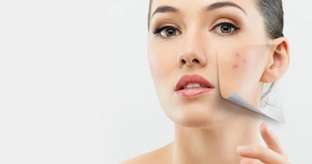 acne treatment