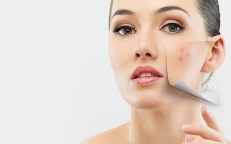 Acne Treatment Tips Without Medication